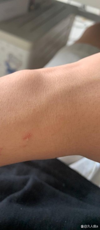 被狗狗抓伤了怎么办的简单介绍