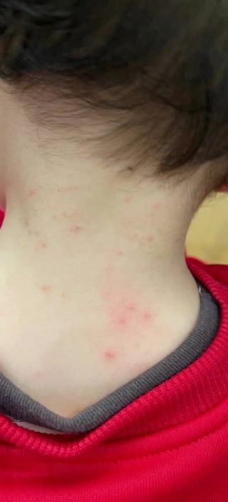 狗狗身上有螨虫会传染人吗？狗去螨虫的最有效土法（最新）