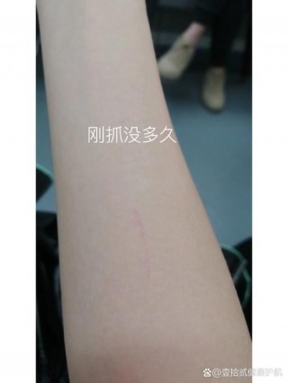 被猫咪抓了没出血，（被猫咪抓了没出血要打针吗）