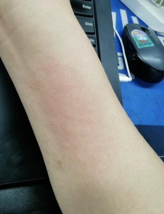 猫咪对什么过敏，对猫过敏大多数是对什么过敏?？