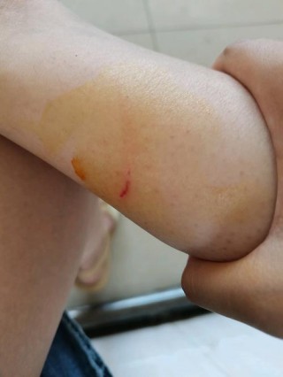 狗狗被蚊子咬了怎么办，（狗狗被蚊子咬了怎么办用什么药）