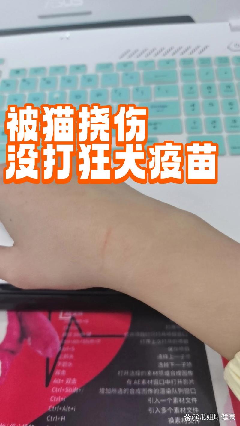 被猫抓了没打针真的没事吗?