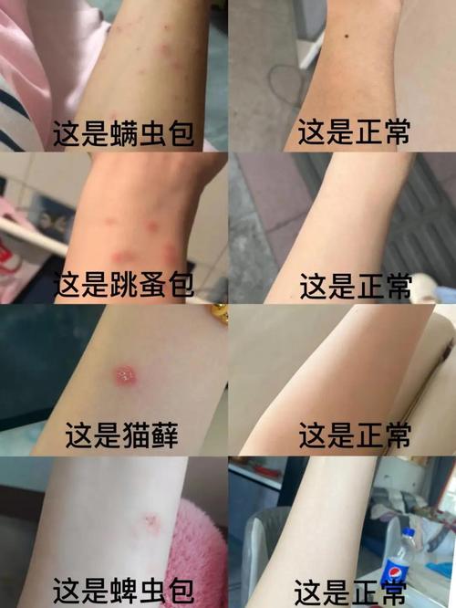 猫耳螨会爬到人身上吗