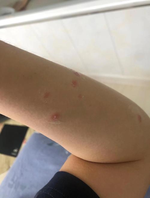 狗螨虫传染给人什么样