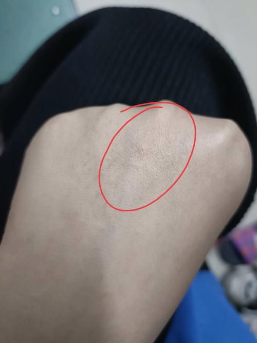 被猫抓咬了一下出血了怎么办?