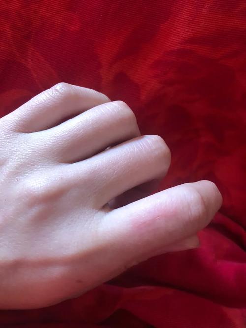 被猫抓了一下红色划痕要打针吗