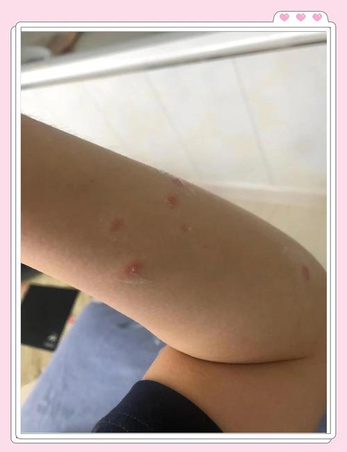 狗狗疥螨会感染人吗?有什么依据?