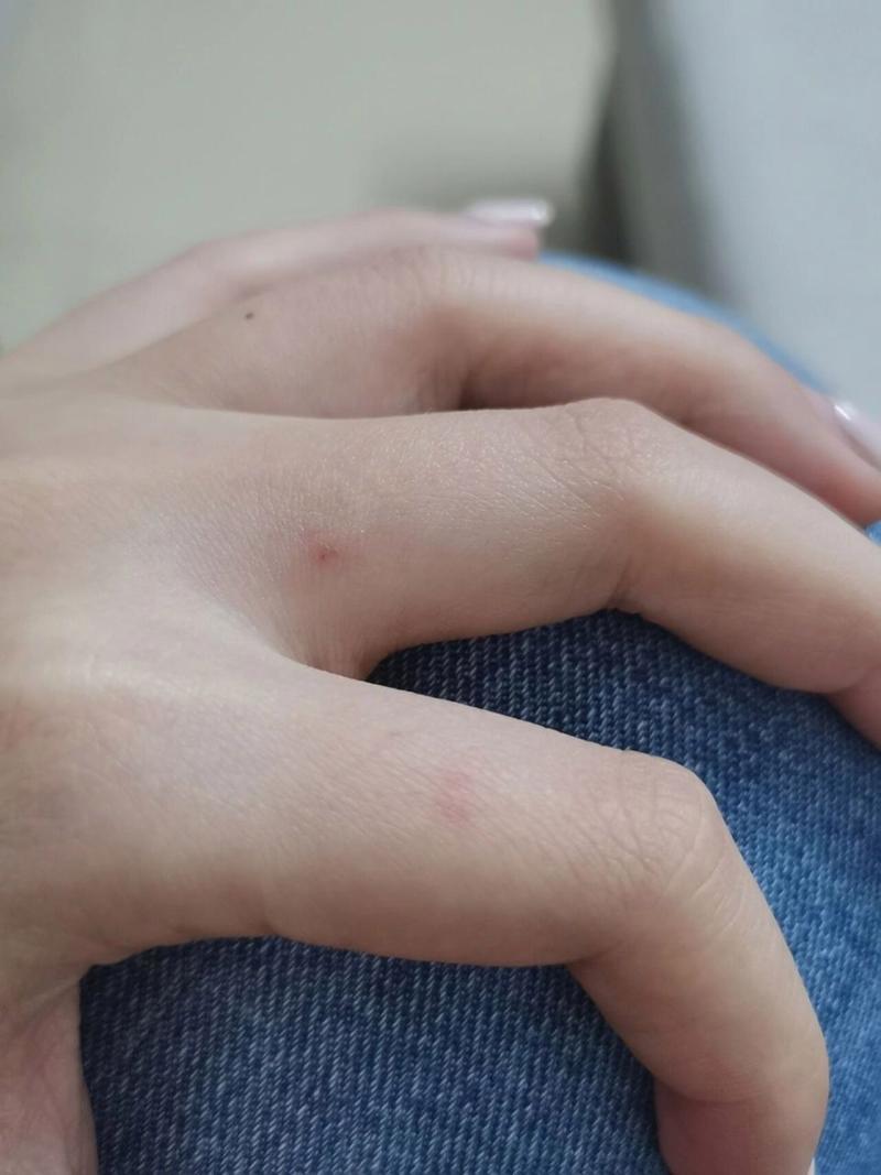 被猫咬破皮没出血要打针吗