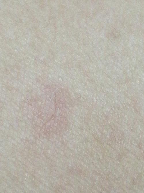 猫咪隔着裤子勾破了一点表皮没出血