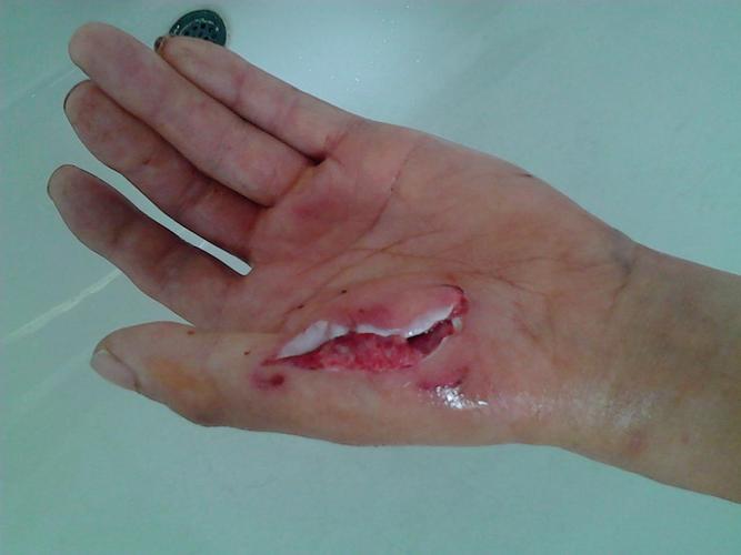 我家的狗被其它狗咬伤了,有两个伤口,伤口还挺深的,但是它不让我们去...