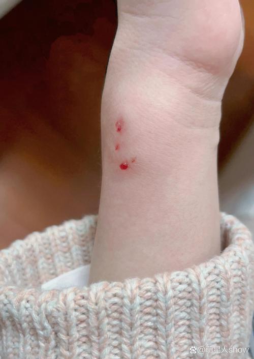 泰迪被大狗咬的很严重花多少钱才能好?