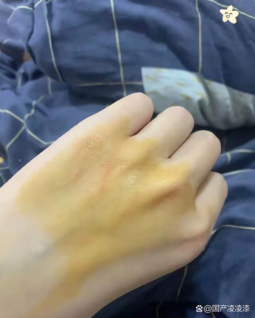 家猫抓了一下出了点血要打疫苗吗?多长时间打