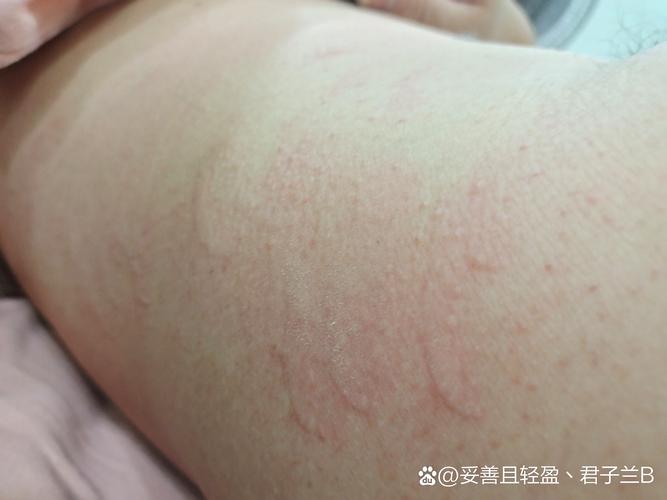 人对狗过敏的症状及治疗