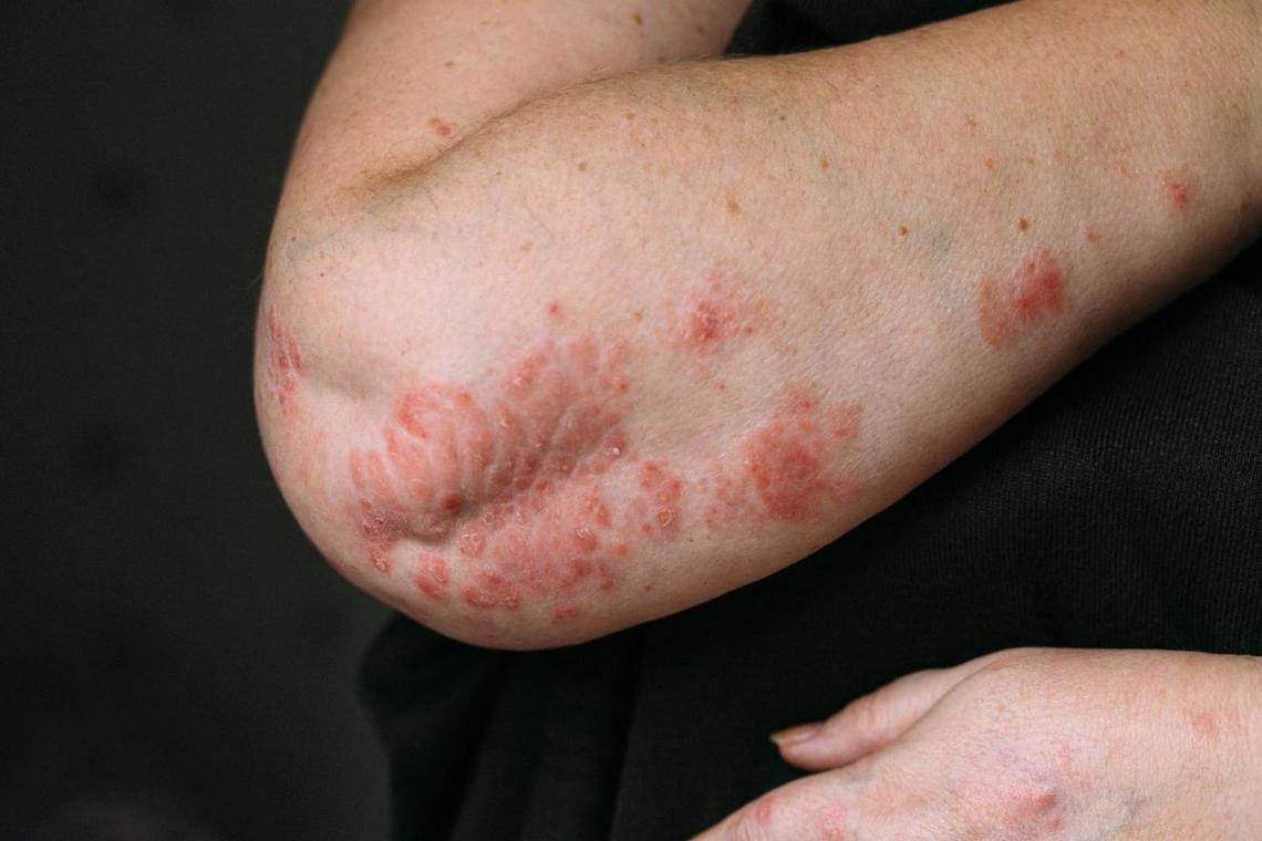 人对狗过敏的症状及治疗方法