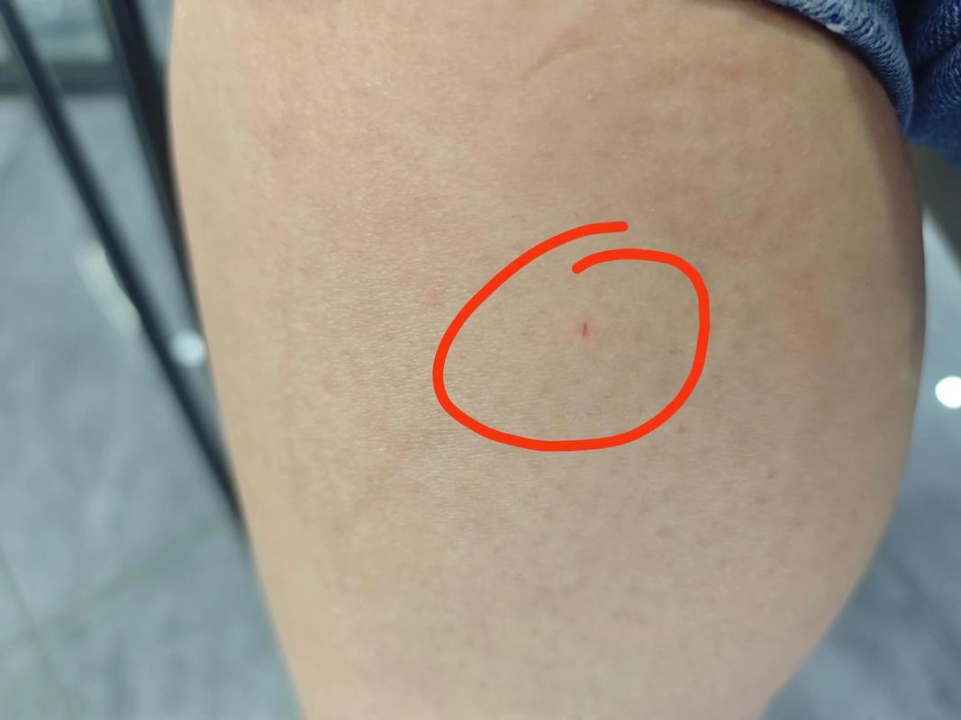 猫抓破了一点皮需要打狂犬疫苗吗