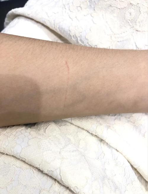 被小猫抓了一下轻微破皮没出血