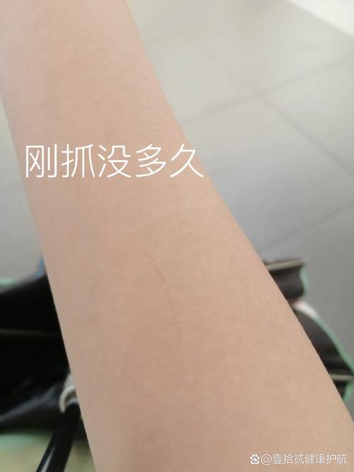 被猫抓了一下没有破皮要打针吗