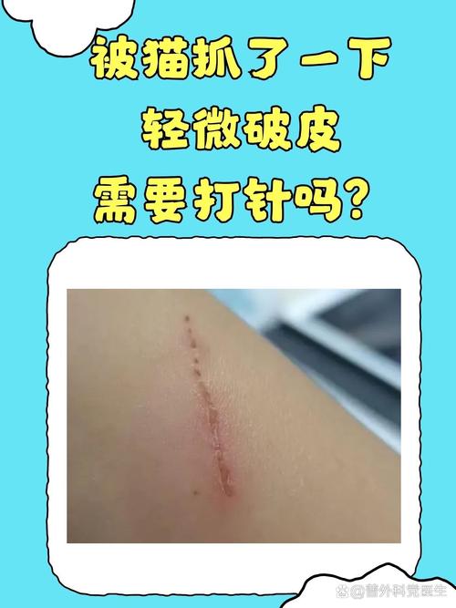 被猫抓了一下轻微破皮要打针吗