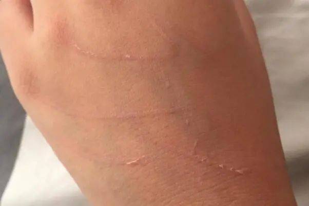 猫咪轻微抓伤要打针吗