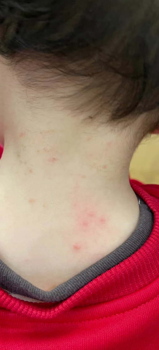 狗螨虫会传染人吗