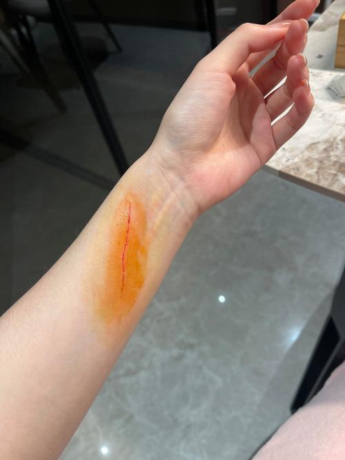 被猫抓了一下轻微破皮要打针吗