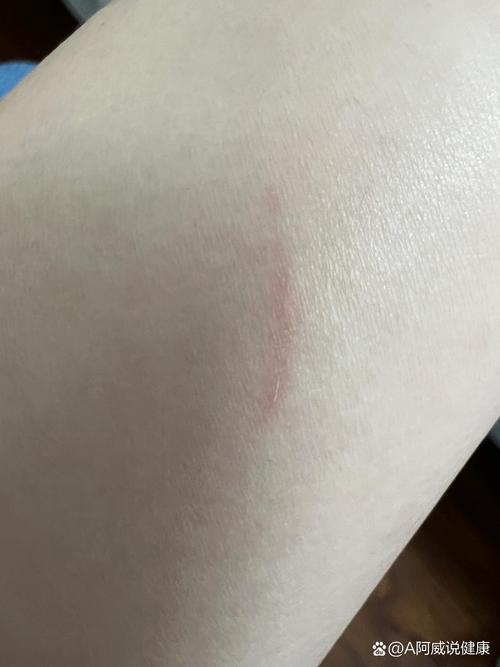 猫抓了一下出了点血要打疫苗吗?